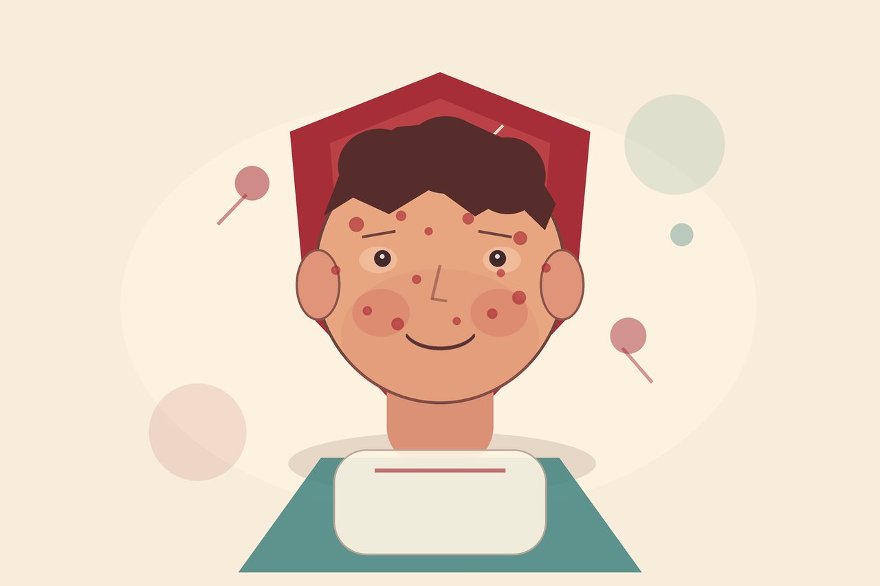 سرخک: علائم، علل، تشخیص، درمان و پیشگیری
