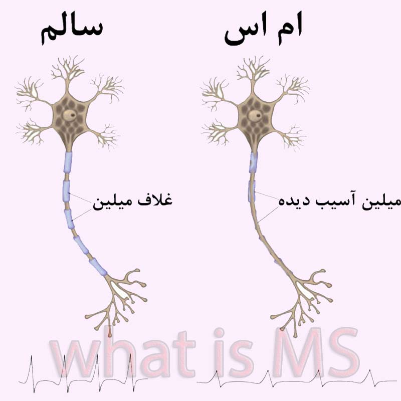 میلین آسیب دیده و سالم در بیماری MS